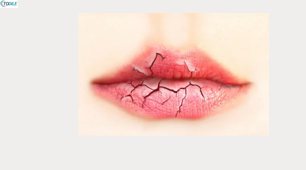 Read more about the article How to Get Rid of Chapped Lips