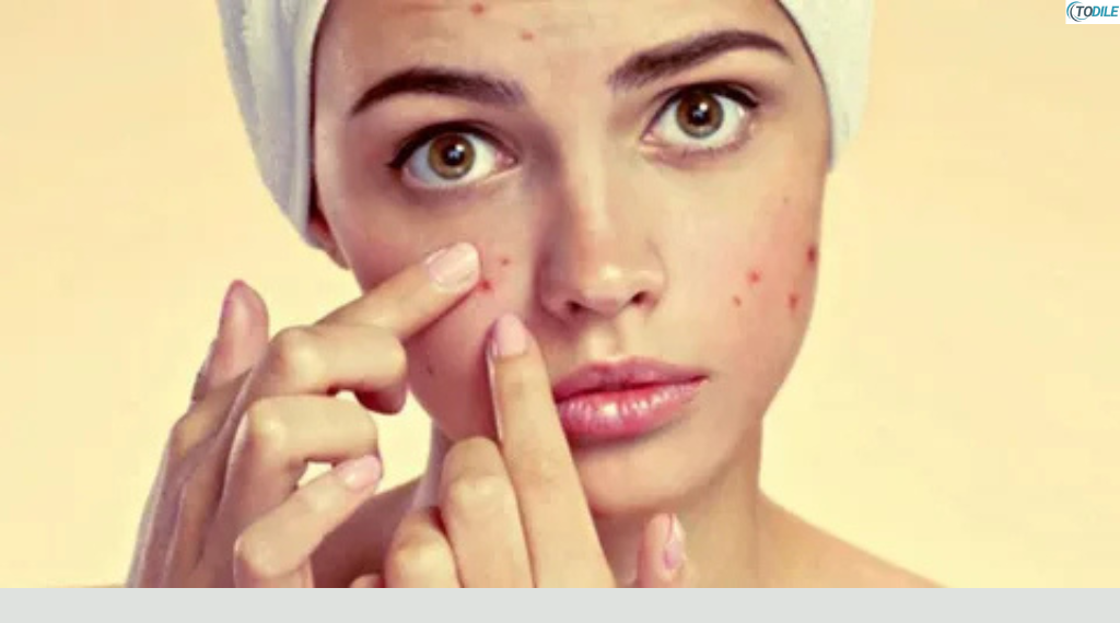 Read more about the article Best Tips for Preventing Cold-Weather Acne