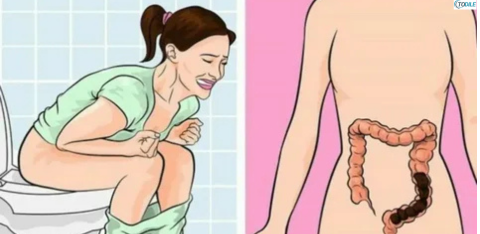 Read more about the article Unusual Signs of Colon Cancer That Women Often Ignore