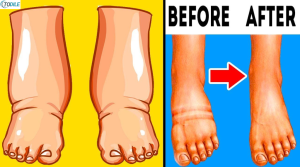 Read more about the article 5 Causes of Water Retention and How to Reverse It