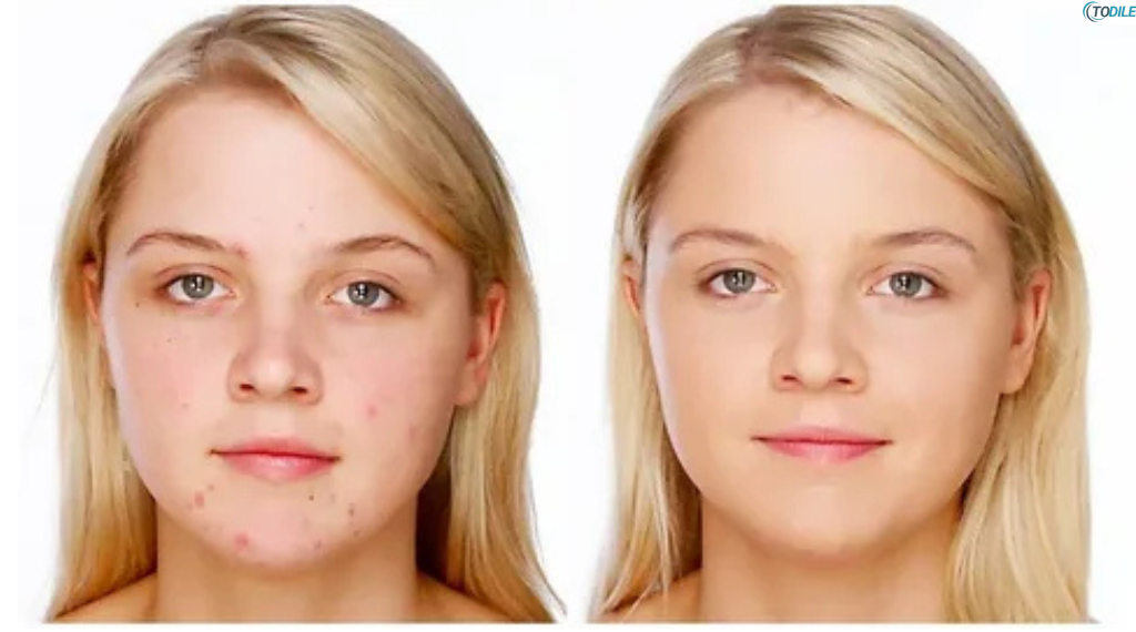Read more about the article How to Remove Facial Scars Naturally