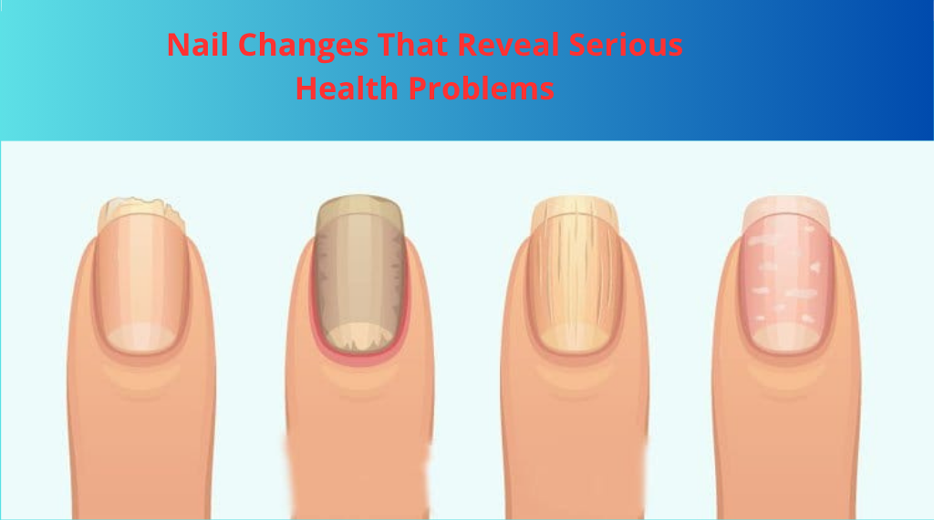 Read more about the article Nail Changes That Reveal Serious Health Problems